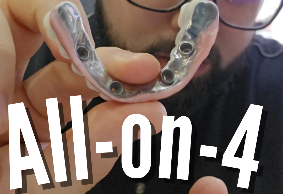 What is an 'All on 4' ? | MJB CARE, Healthcare For The People!